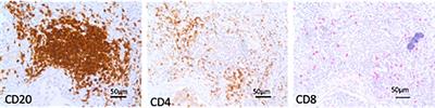 Tertiary lymphoid structures and B-cell infiltration are IPF features with functional consequences